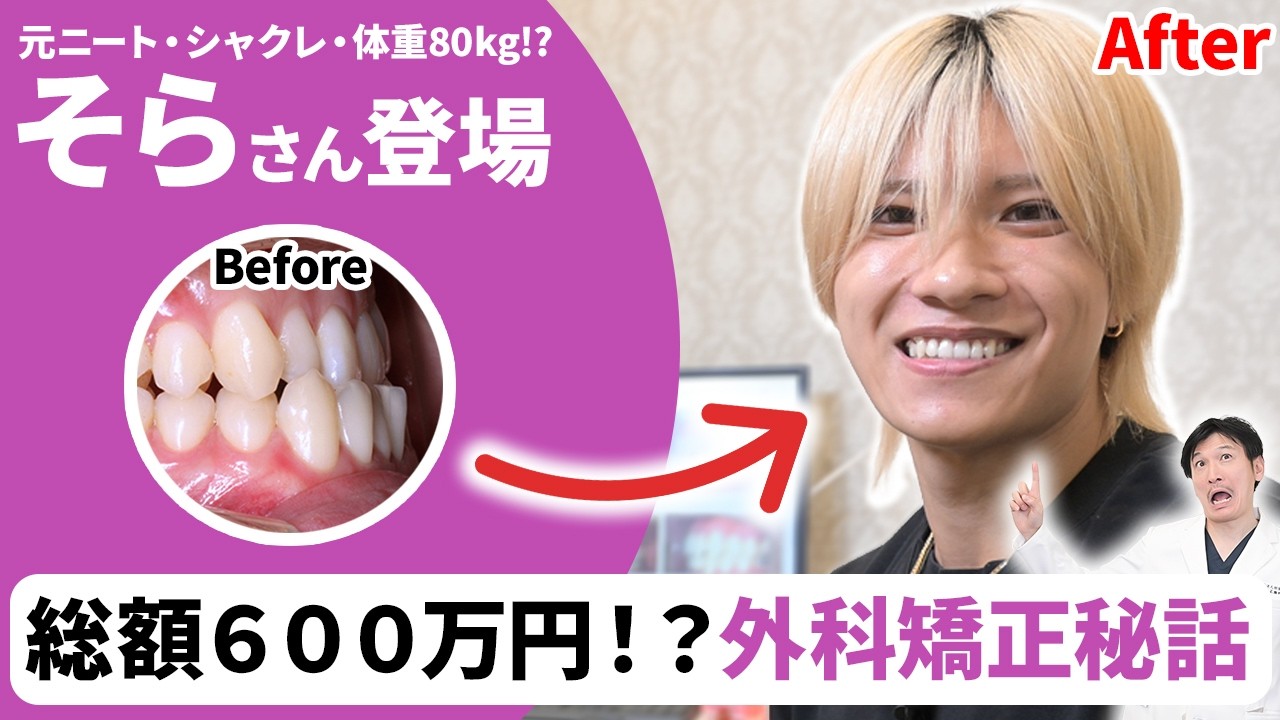 顎切りと歯列矯正でしゃくれを改善された そらさんに当時の思いや感想を聞いてみました！