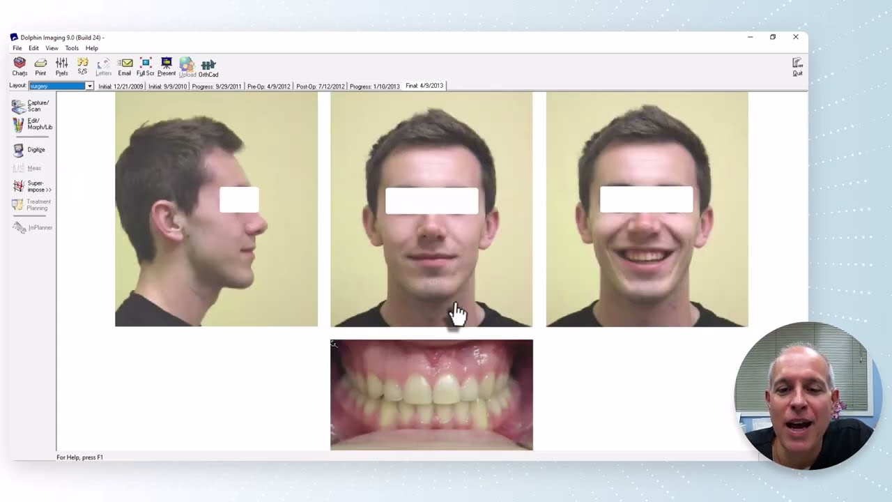 ARA Ortho Case Of The Week - Surgical Open Bite Treatment