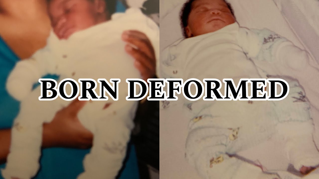 I was born deformed (storytime)