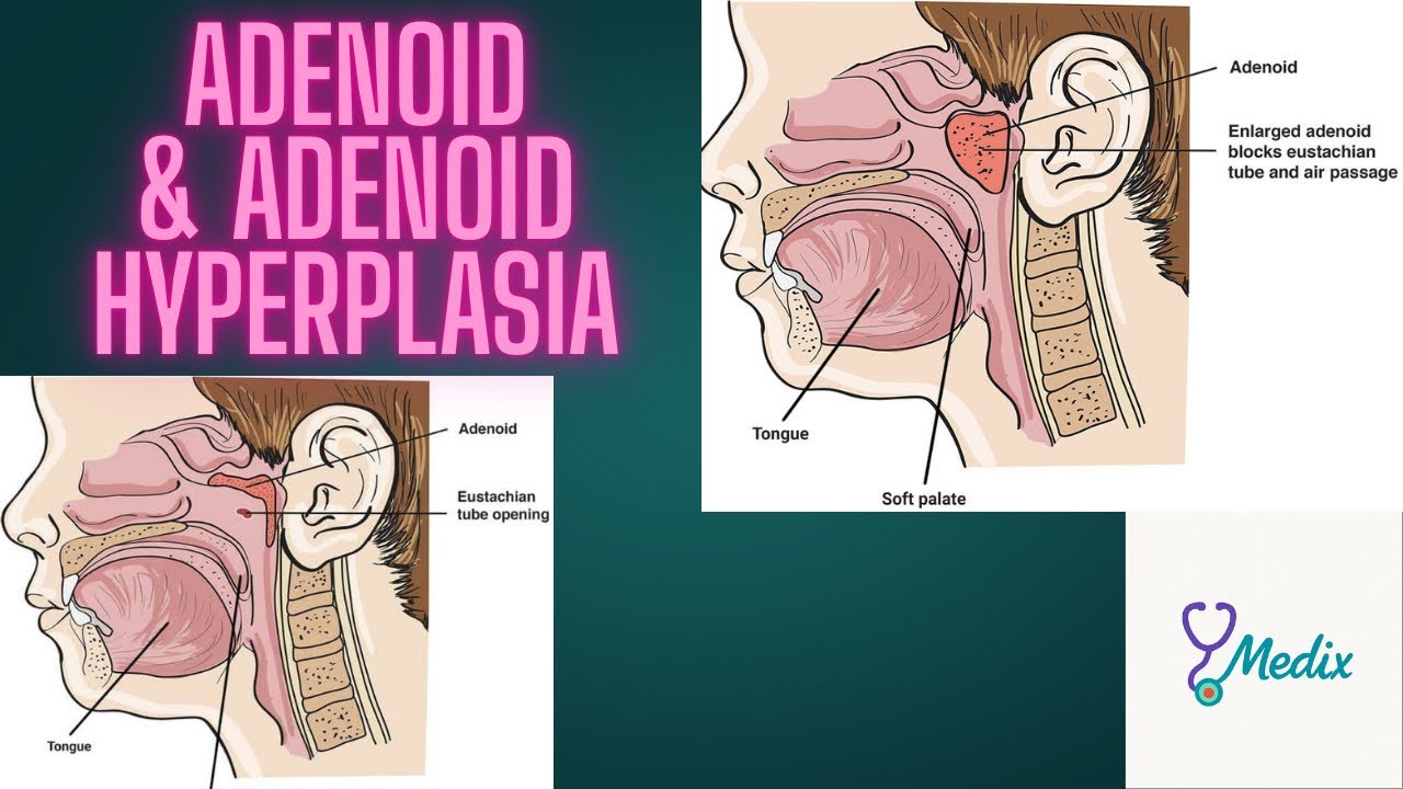 Adenoid Anatomy, location, function, nerve supply | Adenoid hyperplasia Clinical Features,treatment 