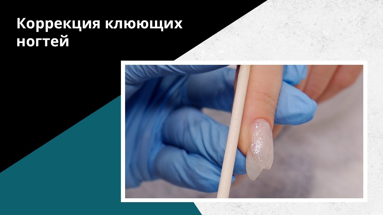 Как ПОДНЯТЬ клюющий ноготь. Коррекция акригелем.