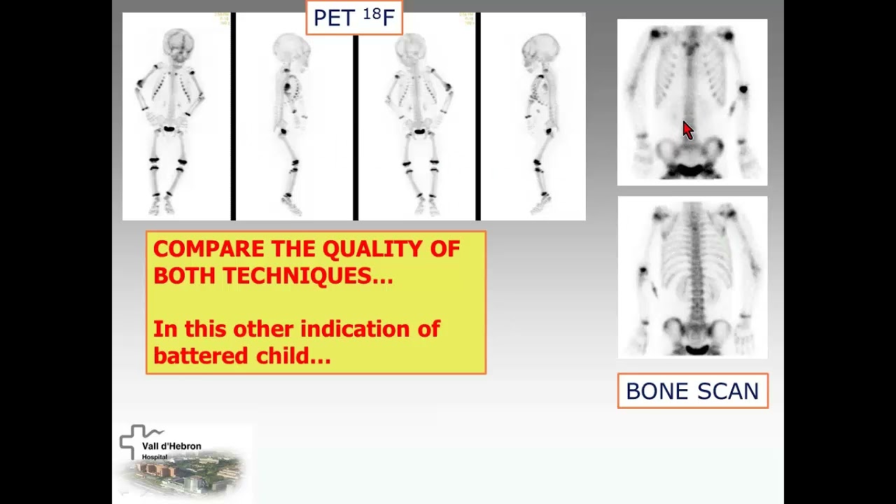 correlative imaging in paediatric bone diseases spect/ct & pet/ct 2015