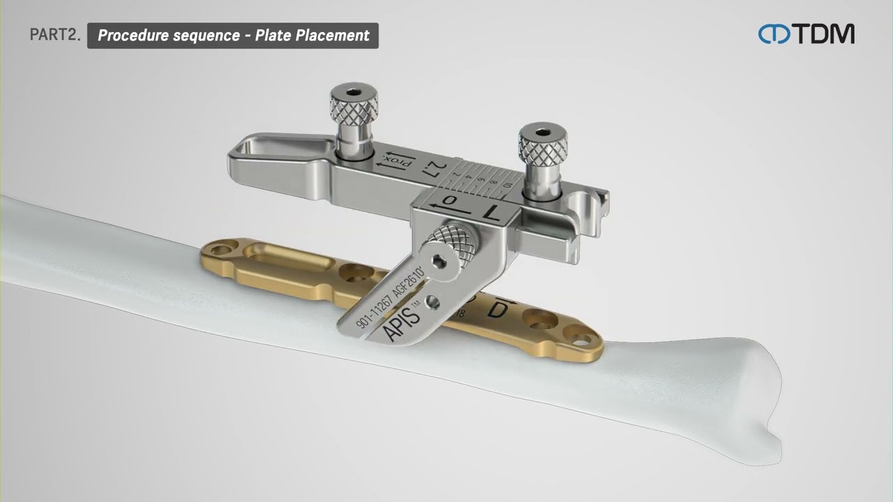 [TDM Korea]  Ulna Shortening System