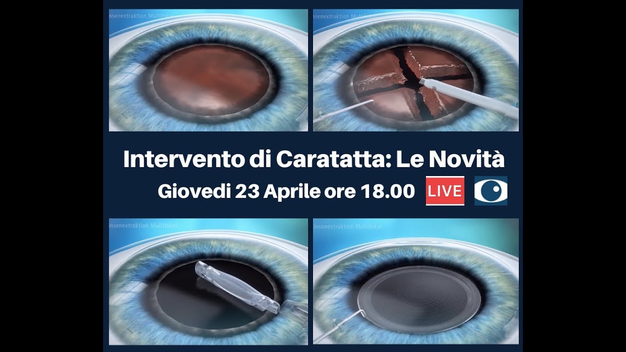 Intervento di Cataratta: Le Novità