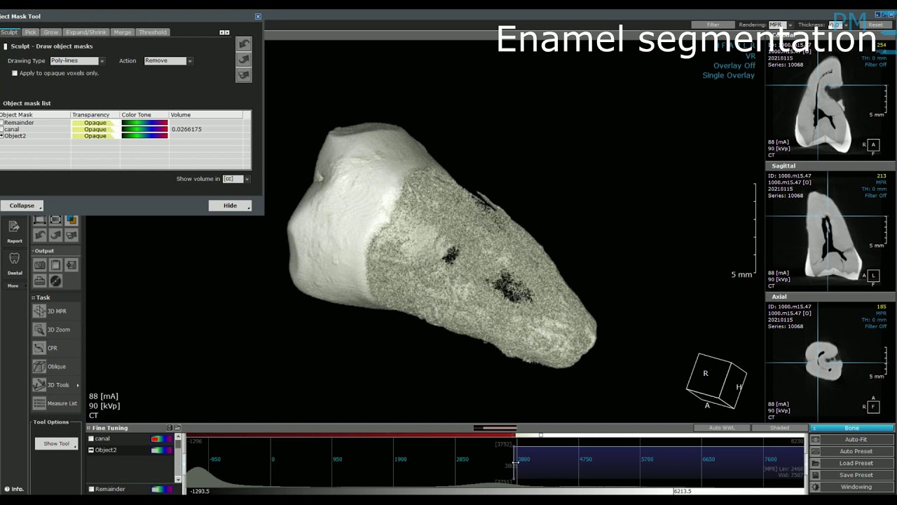 Tooth Segmentation using Ondemand3D