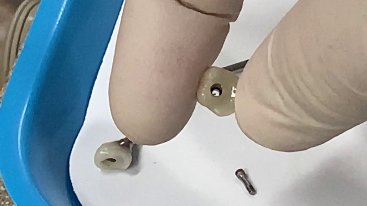 Screw retained Implant crowns