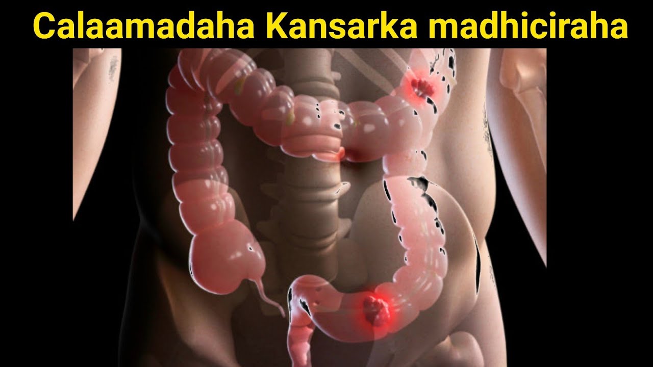 4 Calamad oo lagu garto Kansarka Mindhicirada 