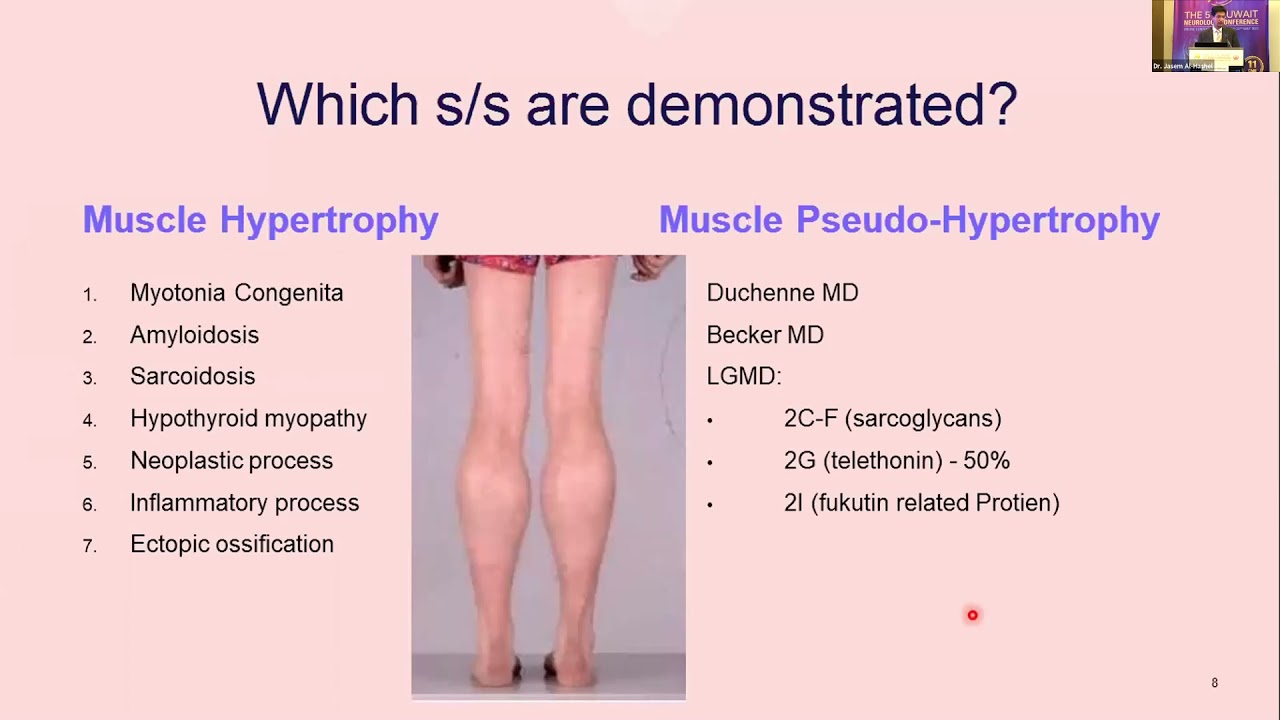 Approach to a patient with myopathy
