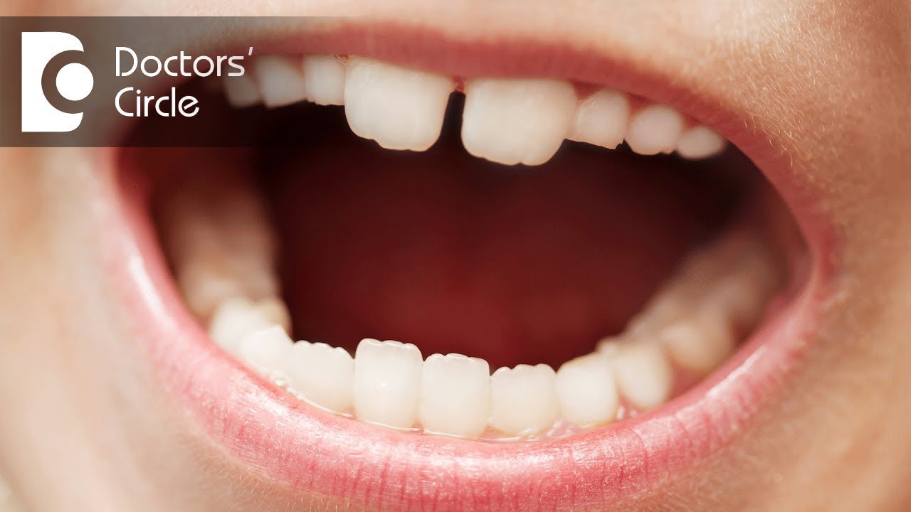 Why do children have crooked teeth? - Dr. Shyam Padmanabhan