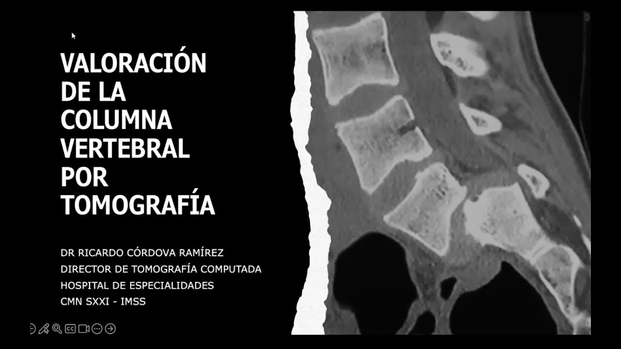 3-2 Valoración de la columna vertebral por Tomografía | Dr. Córdova