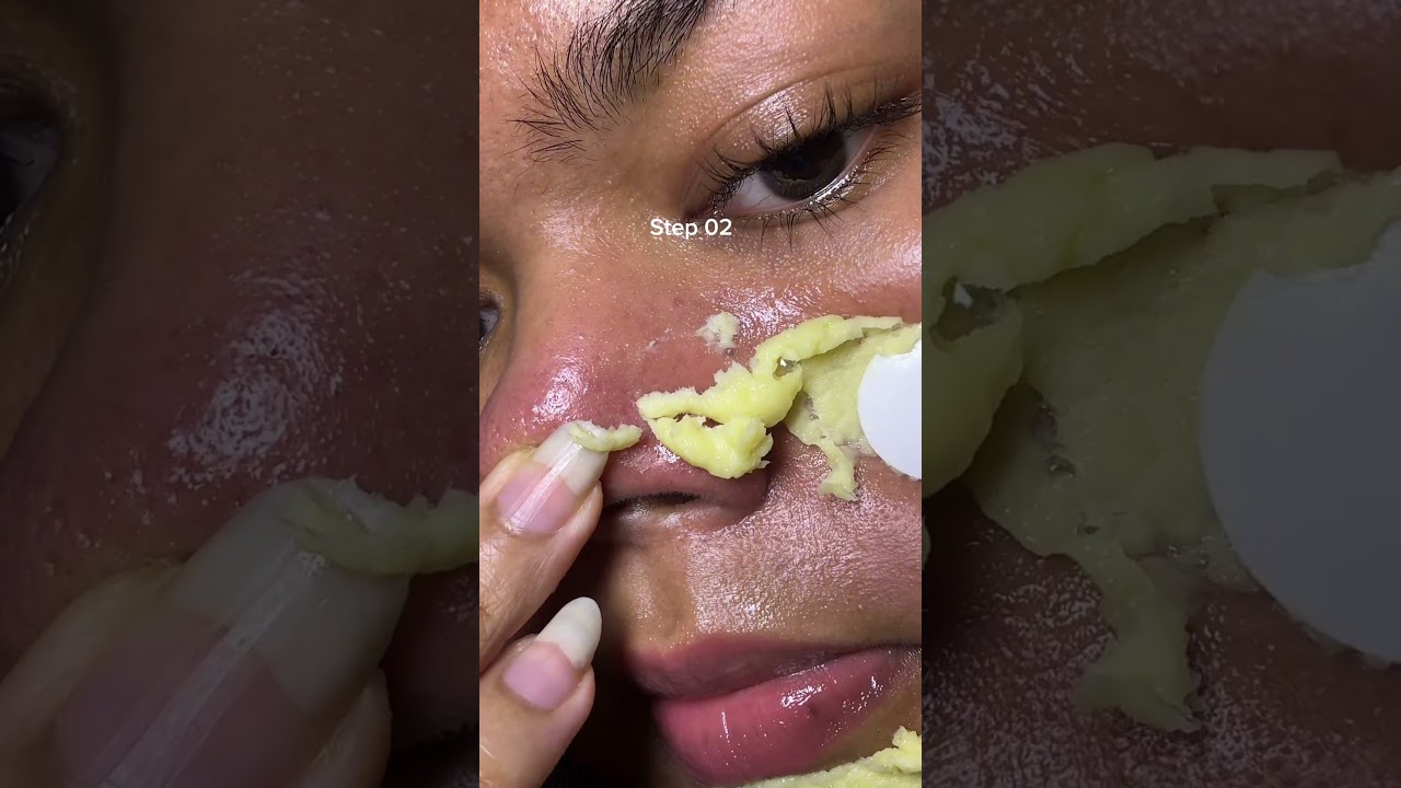 Dealing with blackheads, whiteheads & clogged pores?