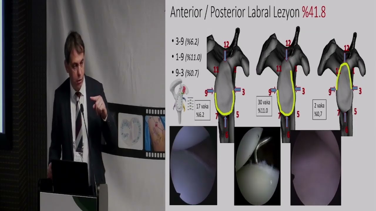 Ulunay Kanatli - Labrum Lezyonlarının Artroskopik Patoanatomisi