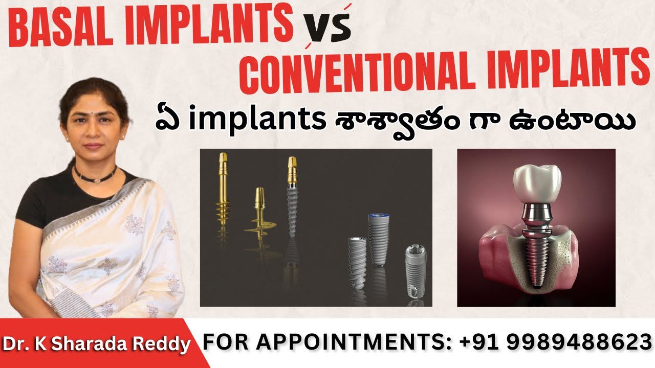 The SHOCKING Truth About Basal Implants and Conventional Implants