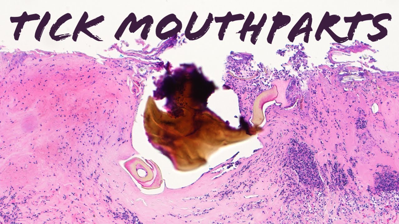 Tick stuck in skin...under the microscope (tick bite mouthparts dermatology pathology dermpath)