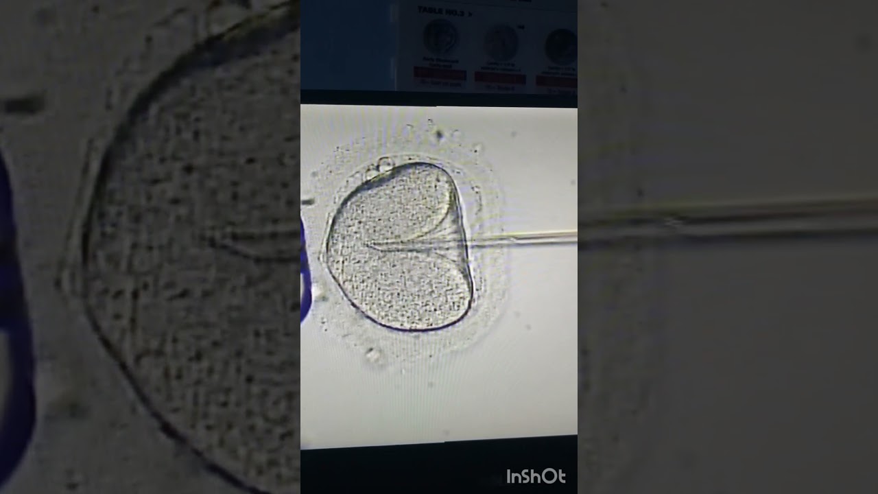 IVF ICSI Procedure, Intracytoplasmic sperm injection #ivf #icsi #ivfprocess #ivfsuccess #ivfjourney