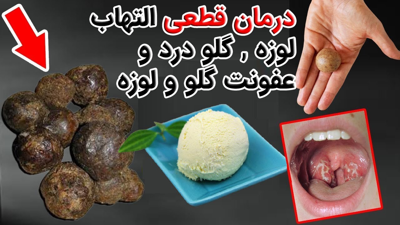 خداحافظی  التهاب لوزه برای همیشه ، یک هدیه الهی برای گلودرد و پاکسازی لوزه ها !