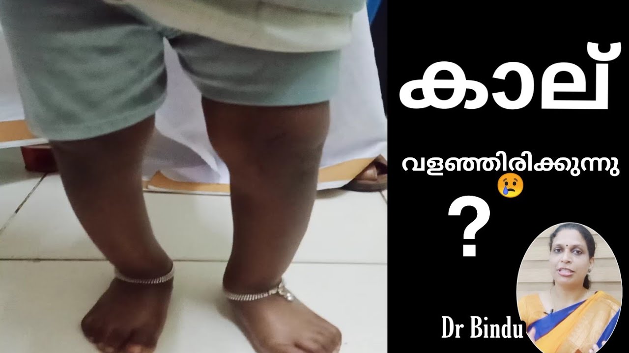 കാല് വളഞ്ഞിരുന്നാൽ എന്തു ചെയ്യണം/ഉഴിഞ്ഞാൽ മാറുമോ/Bowing of legs/Dr Bindu