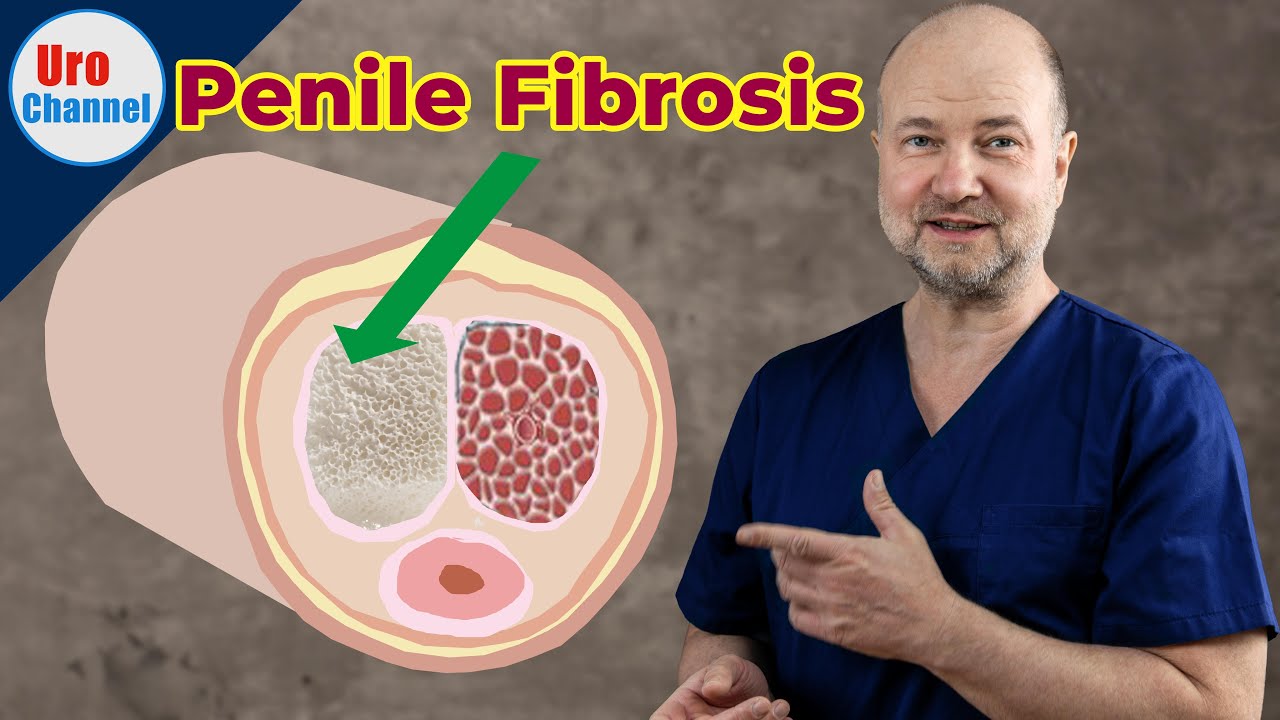 A frequently overlooked reason for Erectile Dysfunction | UroChannel