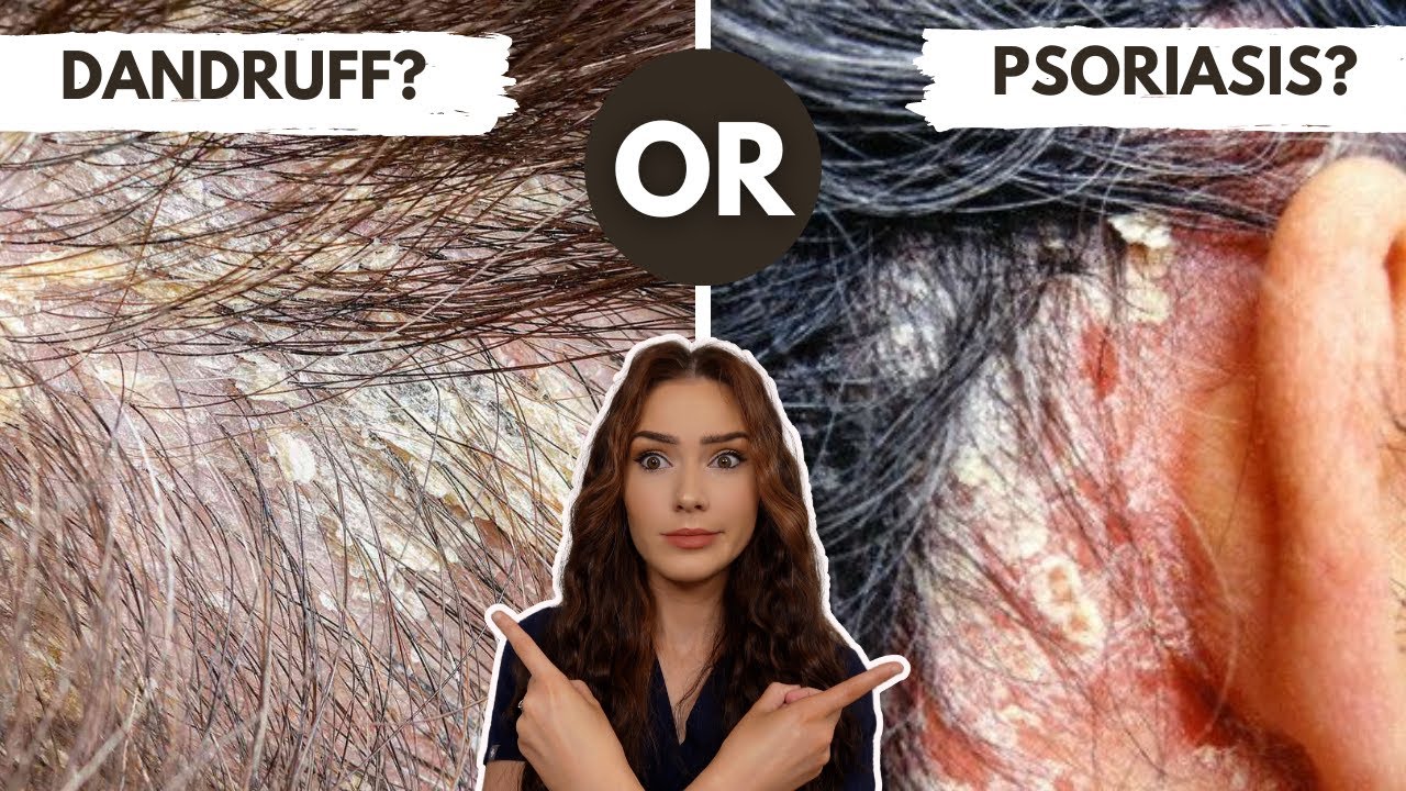 Dandruff or Scalp Psoriasis?! | Difference Between Seborrheic Dermatitis & Psoriasis