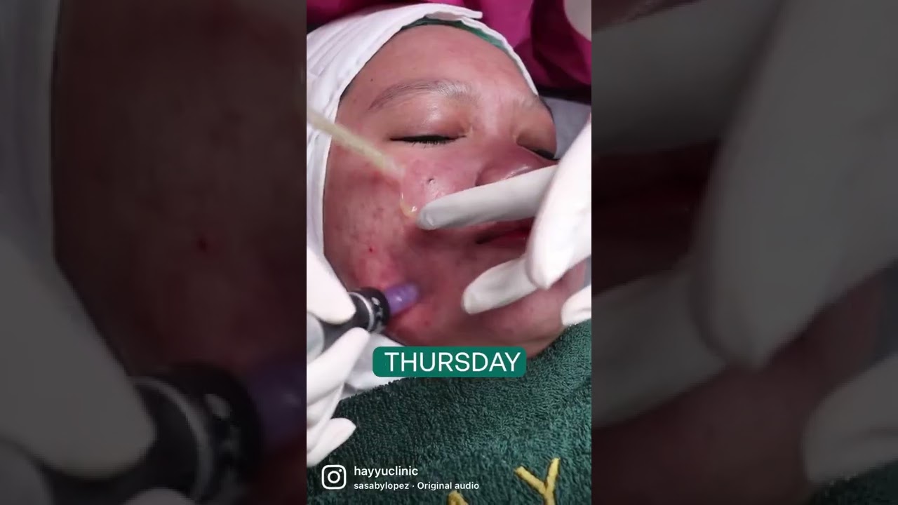 #hayyu #freckles #flekhitam #jerawat #facial #co2laser #bopeng #microneedling #shortvideo #acne