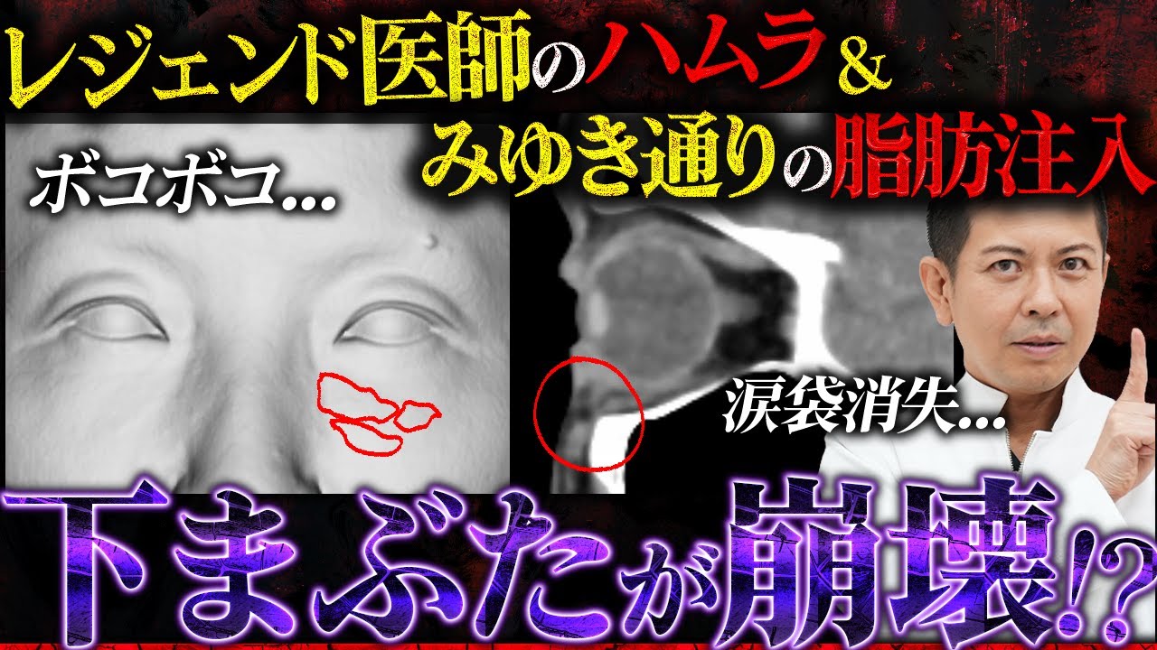 レジェンド医師のハムラで涙袋消失、みゆき通りの脂肪注入でボコボコになった患者様を修正しました！！