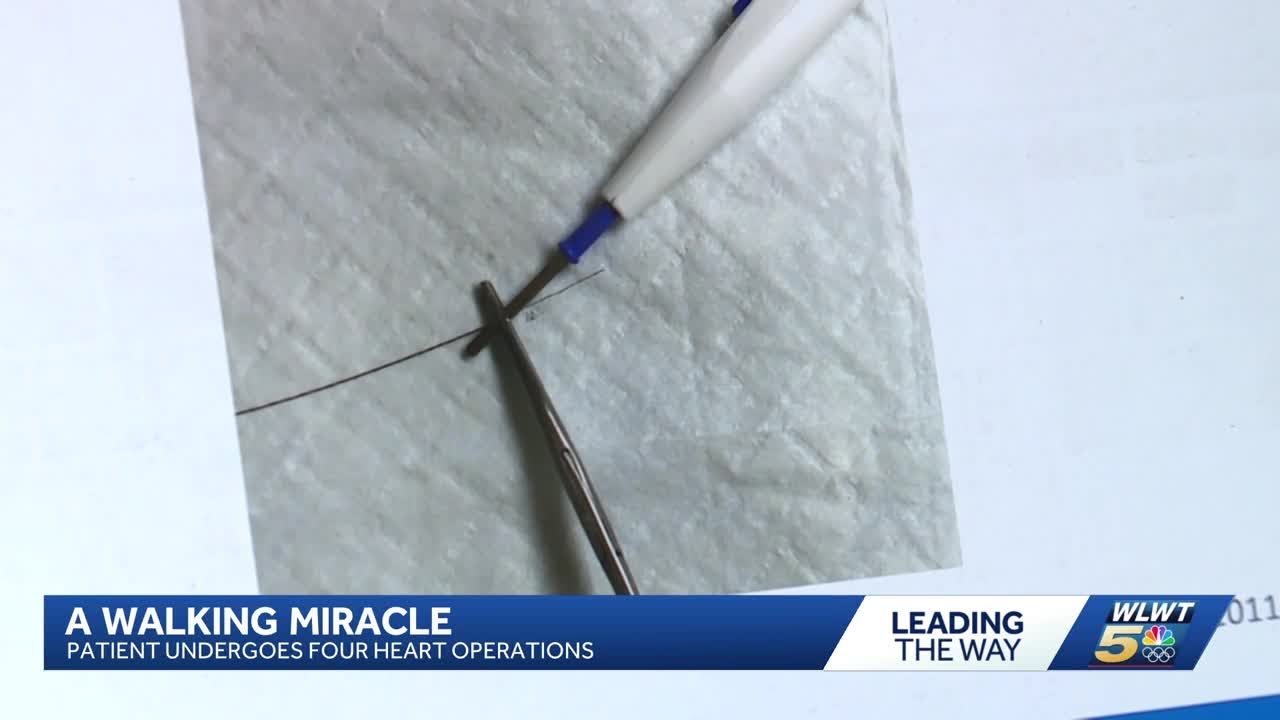 Heart disease survivor undergoes groundbreaking procedure at Christ Hospital