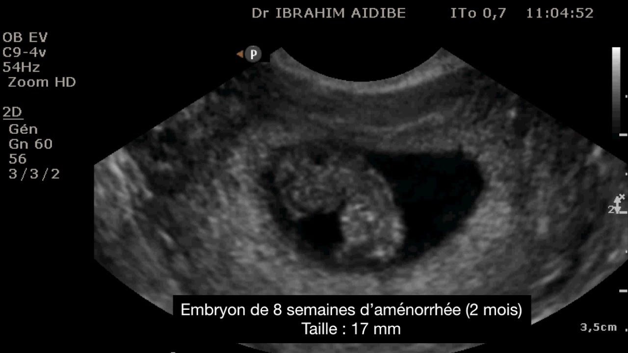 Embryon 8 semaines de grossesse