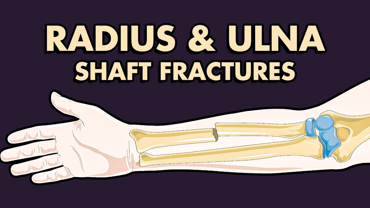 Radius and Ulna Shaft Fractures: Treatment, Complications, Anatomy and Clinical Features