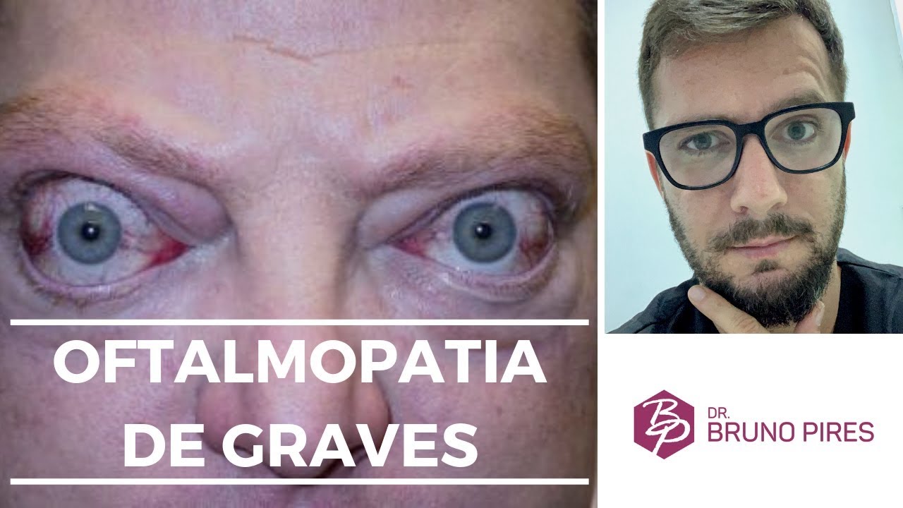 Oftalmopatia de graves | Medicina e Endocrinologia