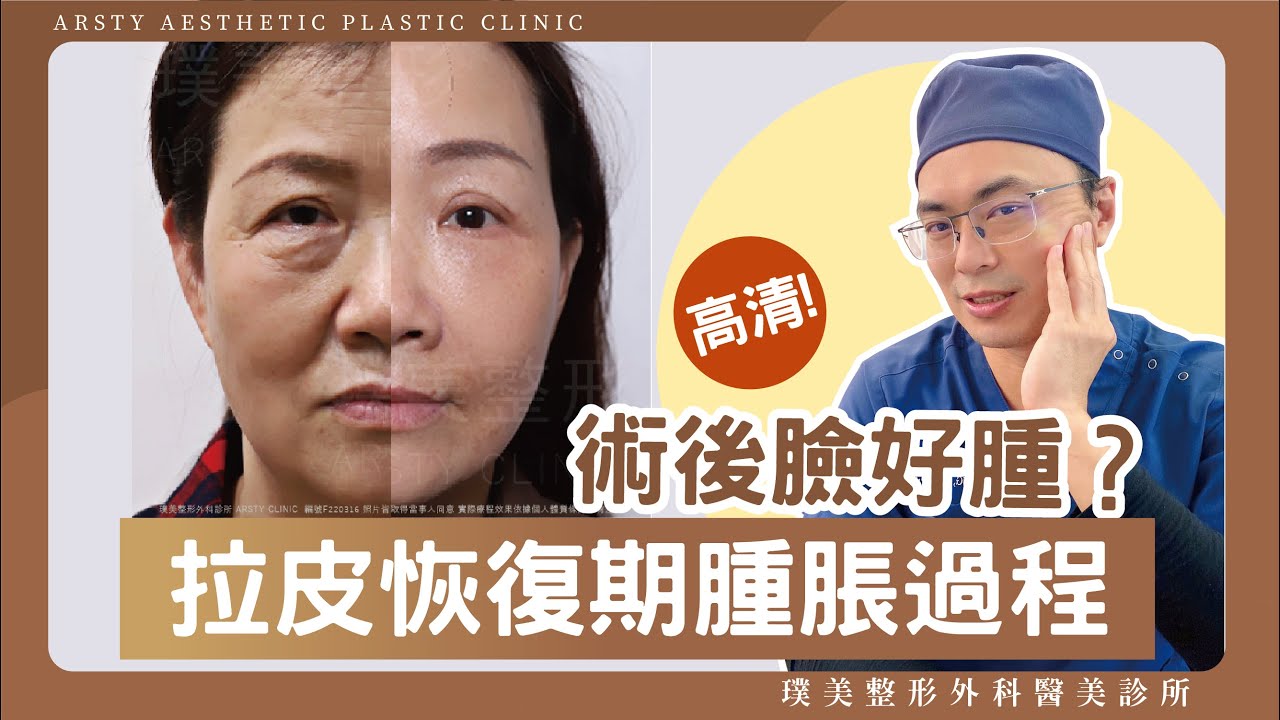 臉部拉皮術後臉好腫？拉皮恢復期腫脹照曝光，結果驚人?! (內有圖) 