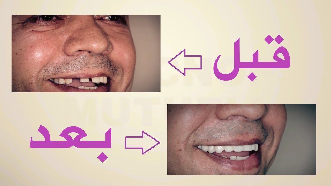 CNOPS  لأول مرة بفيديو حقيقي 📸 مراحل تركيب الأسنان👣👣 خطوة خطوة بالشرح الممل