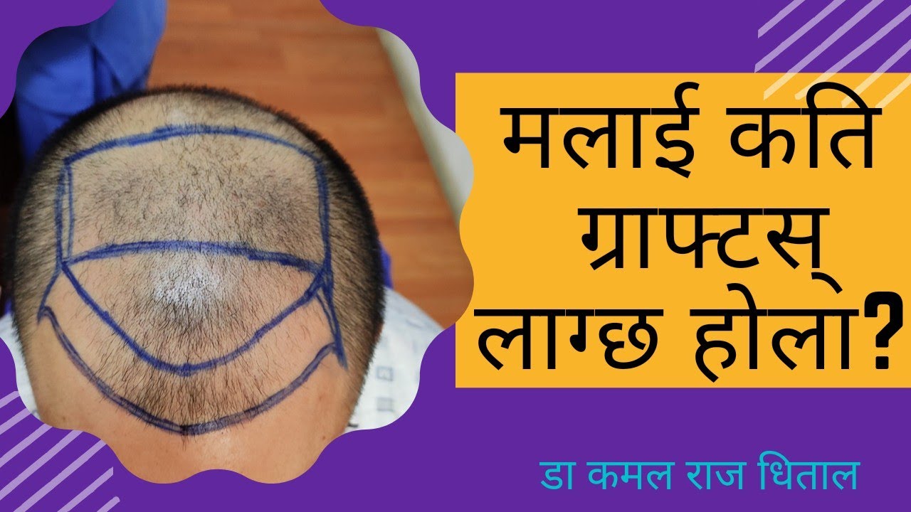 How many grafts, What is the cost, how is the result  of hair transplant in Nepal | Dr kamal  Dhital