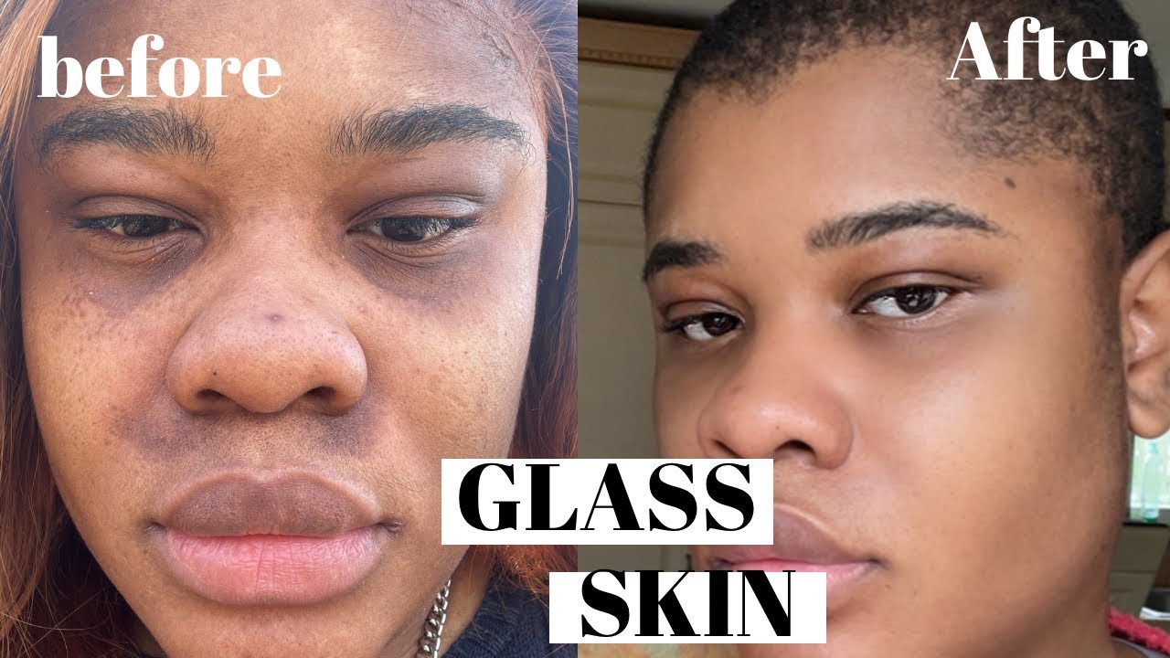COMMENT J'AI &Eacute;LIMIN&Eacute; MES CERNES , MONHYPERPIGMENTATION, L'ACN&Eacute; ET LES TACHES SOMBRE !!