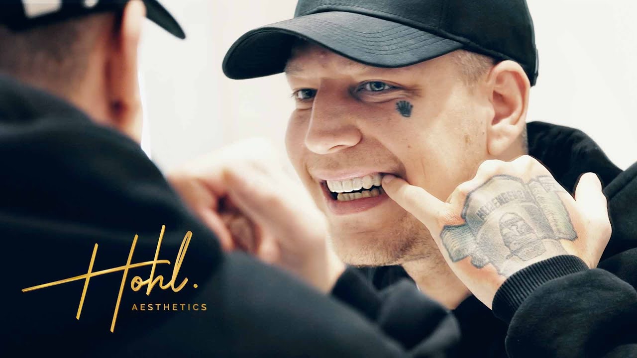 SmileDesign für @MontanaBlack by Hohl AESTHETICS - Die Probefahrt für Deine neuen Zähne!