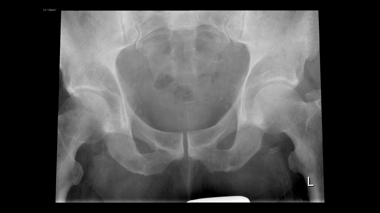 Pelvic Radiograph part 3