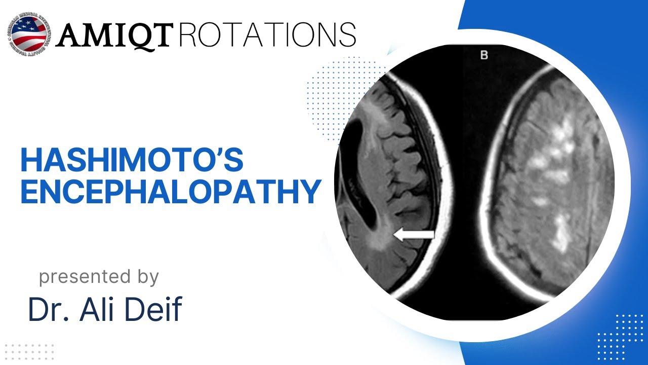 Dr ALI DEIF, HASHIMOTO ENCEPHALOPATHY