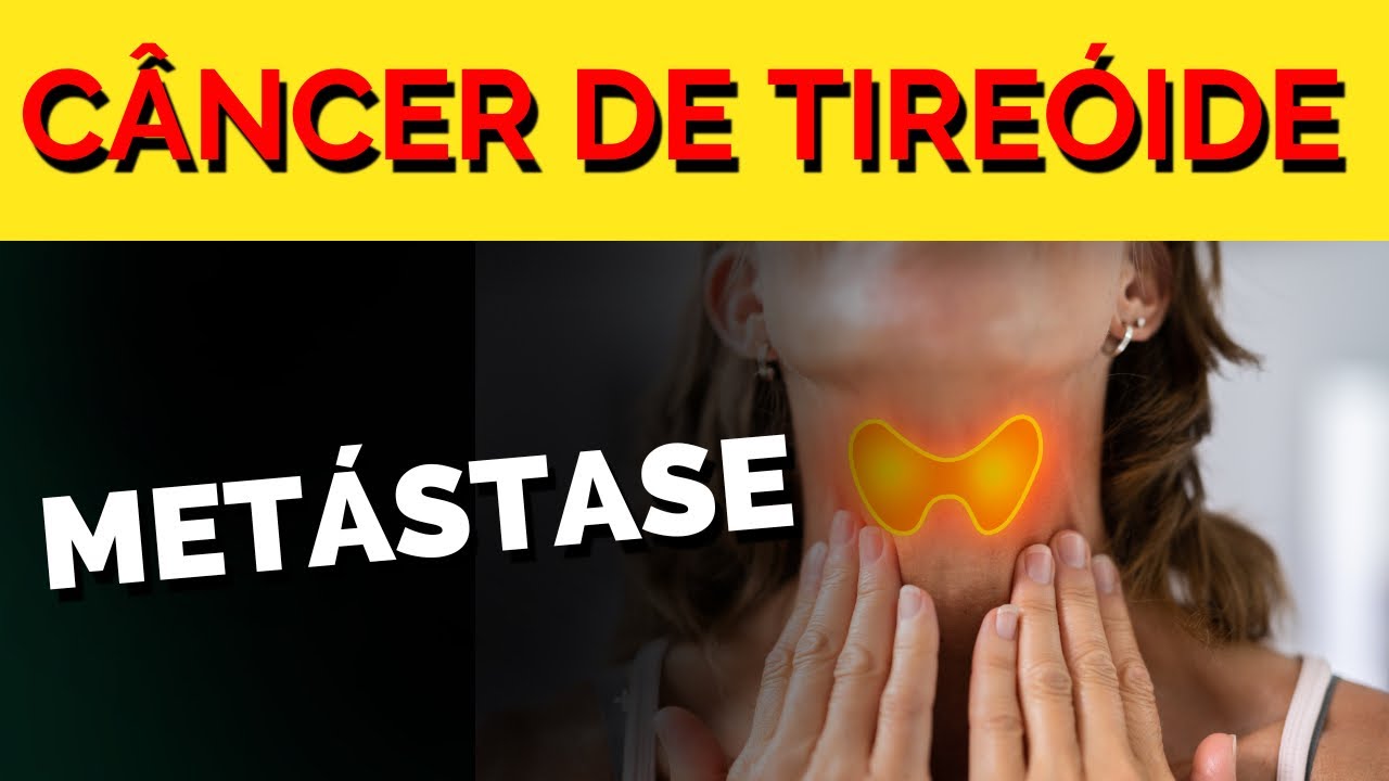 Metástase do câncer de tireóide, metástase nos linfonodos no câncer de tireóide