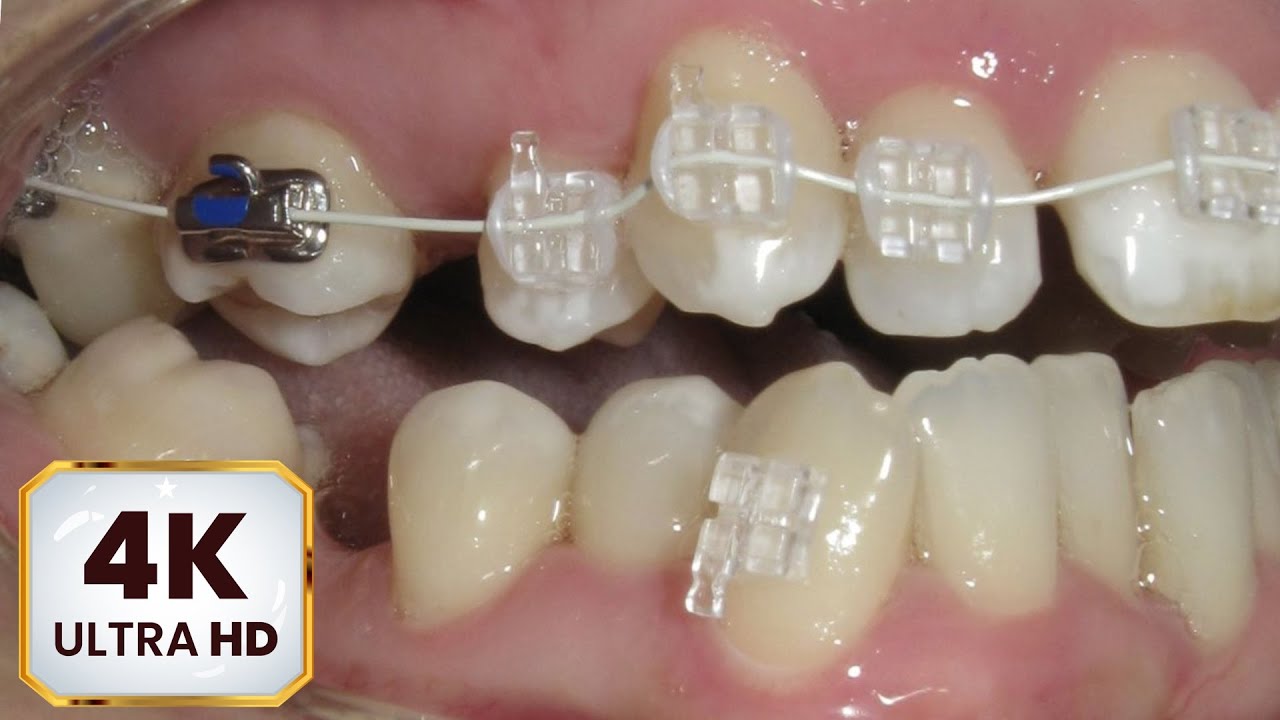 HOW #BRACES WORK Sapphire braces. Protruding chin in ADULT patient! #4k #Crossbite  #timelapse