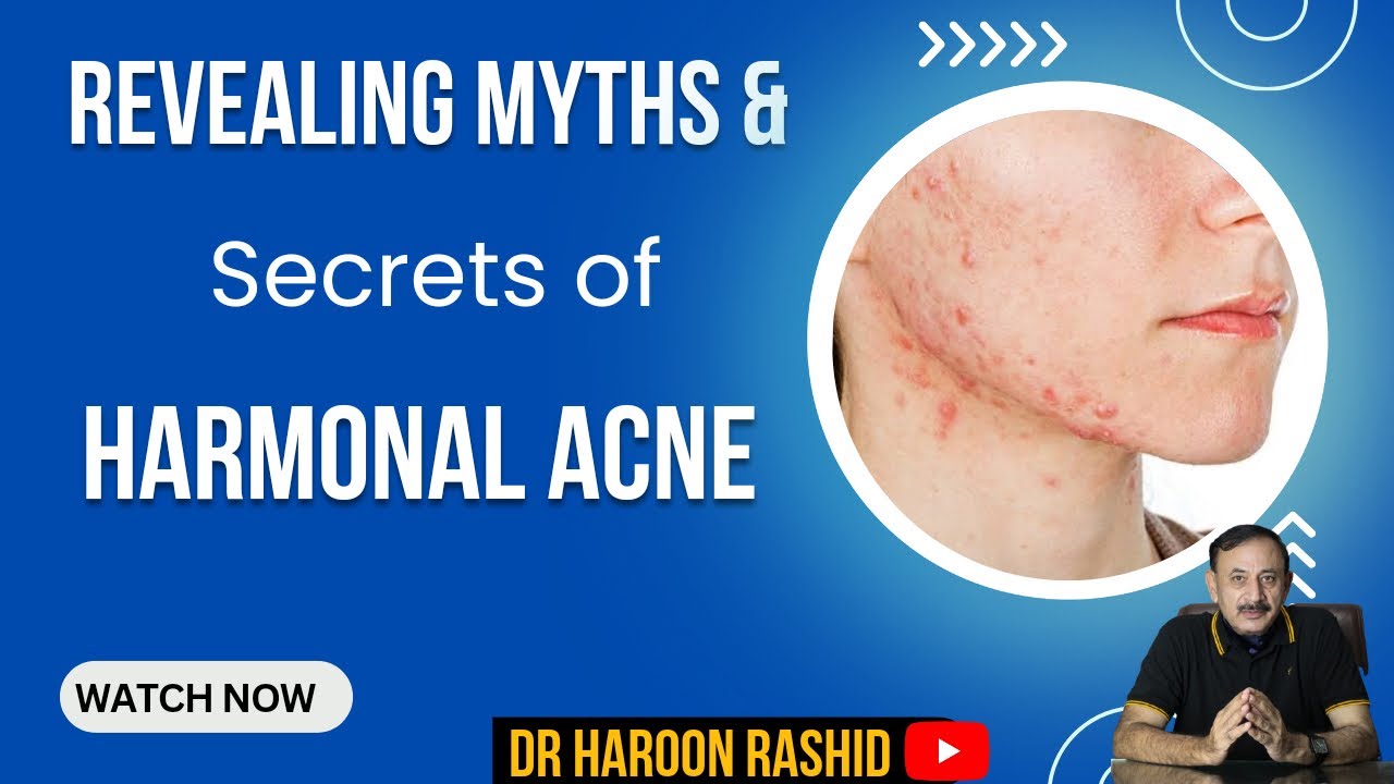 Revealing Myths & Secrets of Harmonal Acne]] New video by Dr Haroon Rashid 2025