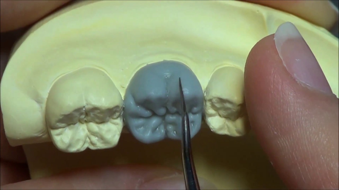 Live wax up - Lower 1st molar(occlusion)