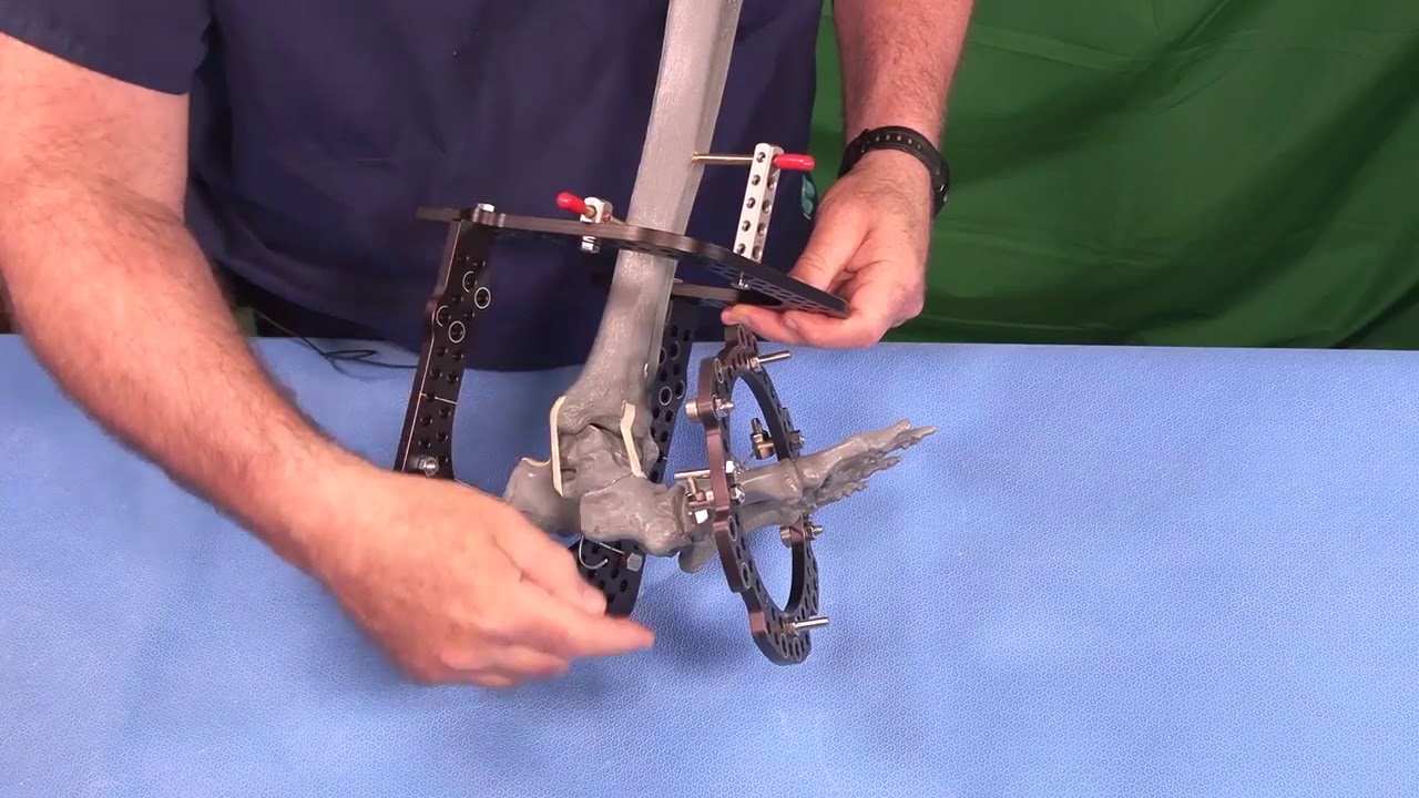 Midfoot Deformity  Hexapod Butt Frame Fixation Technique and Planning