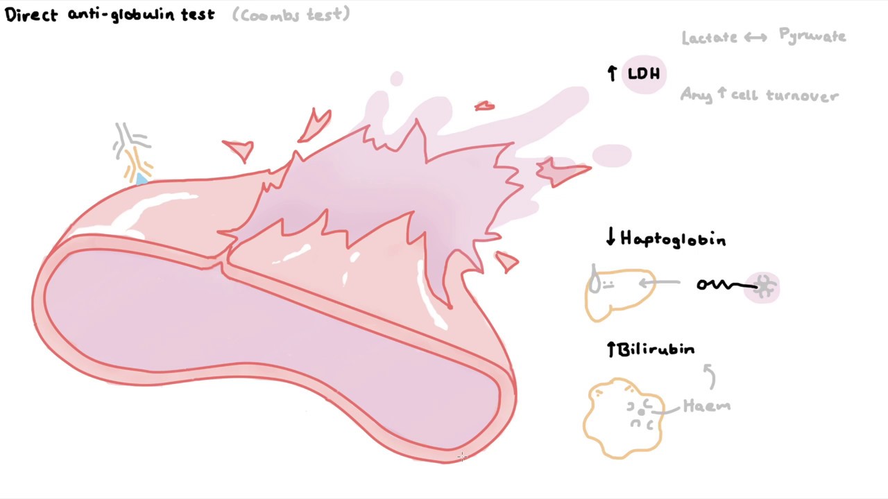 How to diagnose haemolytic anaemia