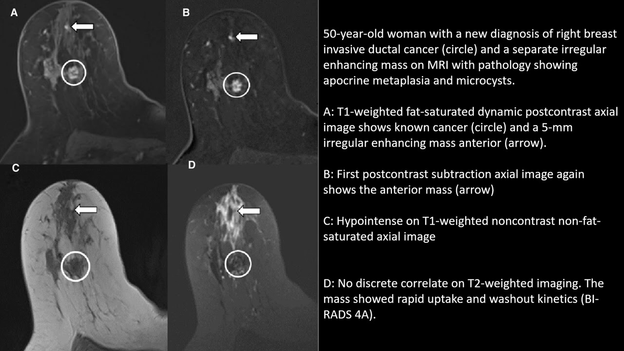 Fibrocystic Changes of the Breast: Radiologic–Pathologic Correlation of MRI