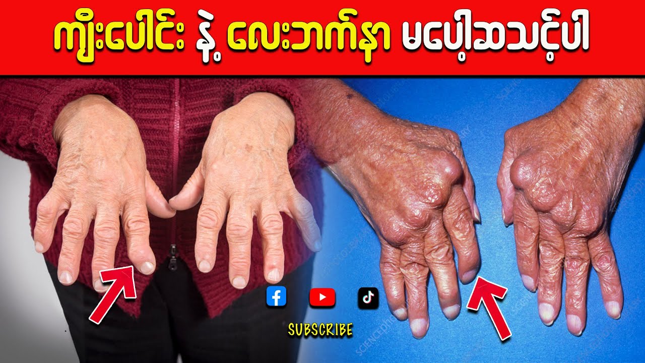 အဆစ်အမြစ်နာ နဲ့ ကျီးပေါင်း၊ လေးဘက်နာ မပေါ့ဆသင့်ပါ | အဆစ်အမြစ်နာရင် သတိထားပါ