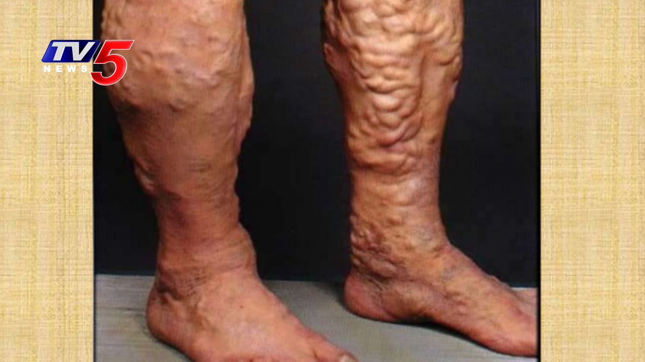 Causes & Treatments For Varicose Veins | Dr Chalapathi Rao's  IR Centre | Health File | TV5 News