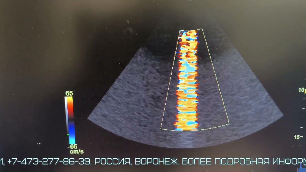 3Sc Scan head change Ремонт кардио датчика 3Sc c заменой акустического модуля