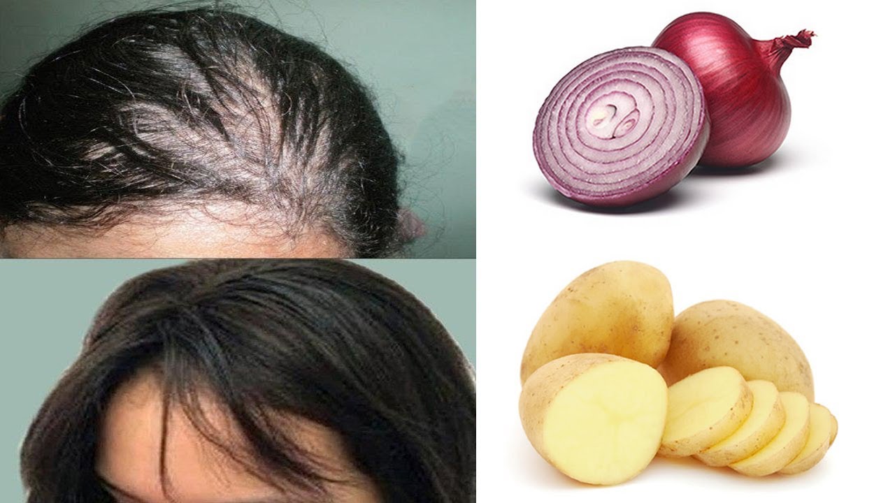 How to Grow Long Hair Naturally Fast with Potato & Onion | Magical Hair Growth Treatment 100% Works