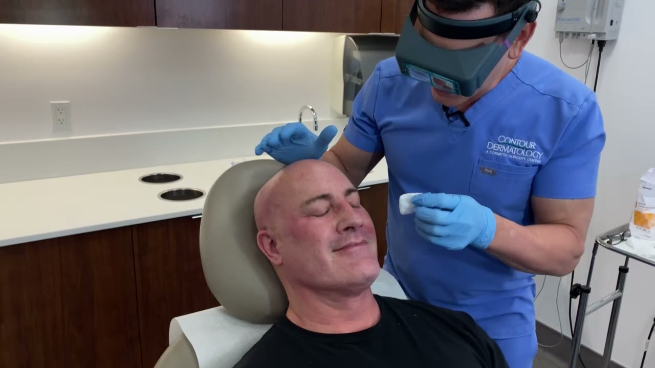 TCA Peel application performed by Dr. Timothy Jochen M.D.