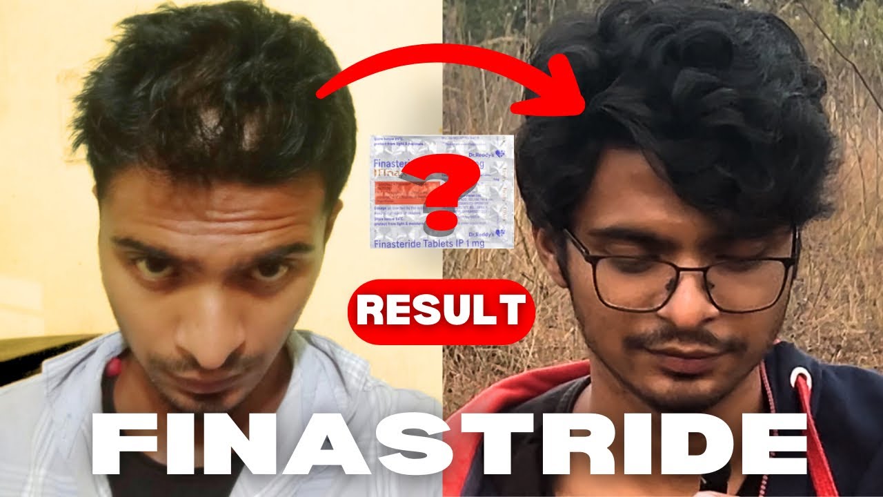 Thinking of Using Finasteride? Watch This First