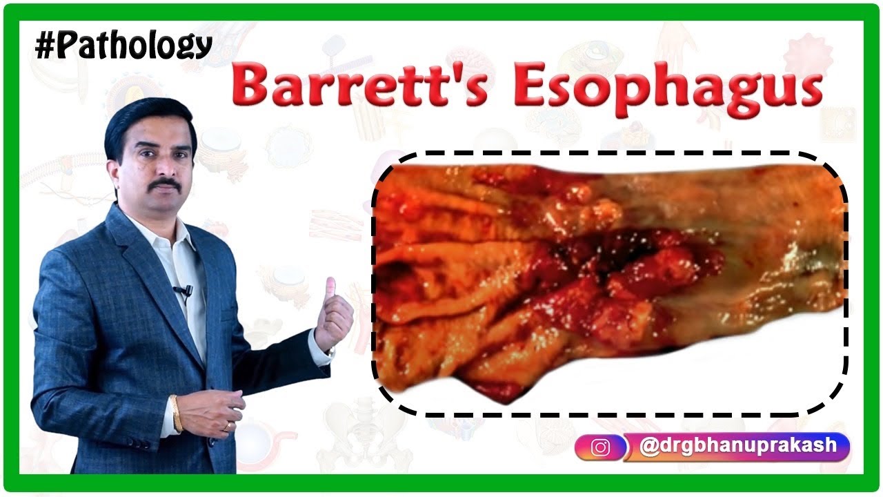Barrett's esophagus Pathology Lecture - Usmle Quick review - Dr Bhanu prakash